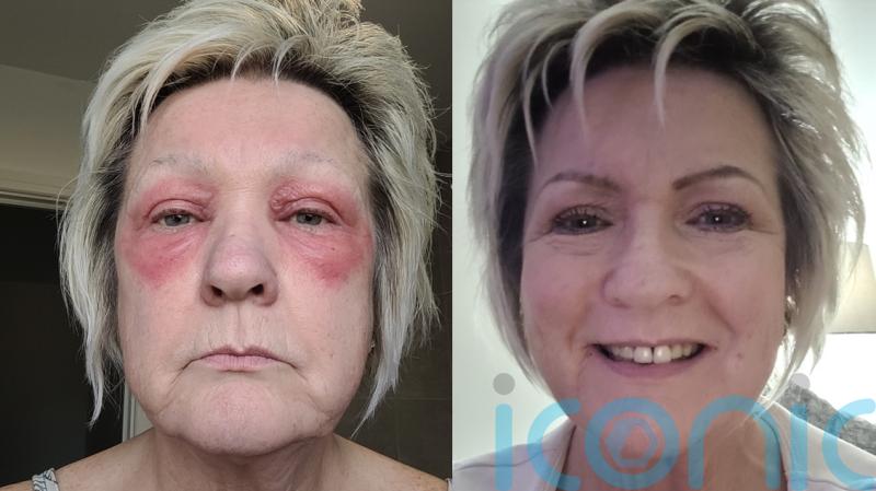 Mum who felt like monster after waking with red rings around her eyes that burned like acid finds ‘godsend’ cure
