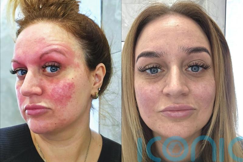 Mum whose face was suddenly ‘sunburnt’ by acne after having first child finds ‘miracle’ cure after six years of pain