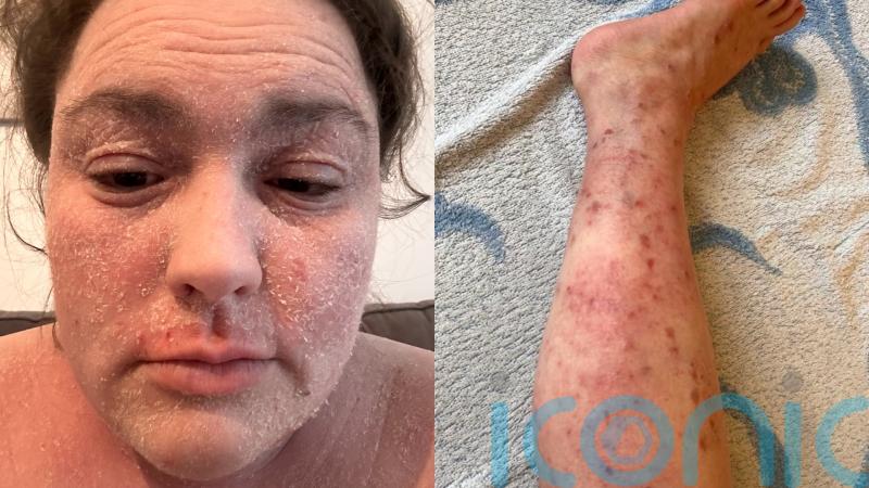 ‘My extreme eczema cost me a job and made me a recluse but sharing my skin on social media makes me more confident’