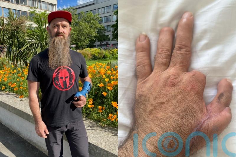 Carpenter who sawed off two digits on hand in work accident has ‘second chance’ at career after toe-to-thumb transplant