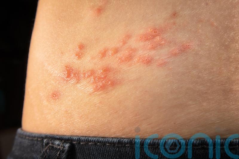 Shingles vaccine can delay onset of dementia – study