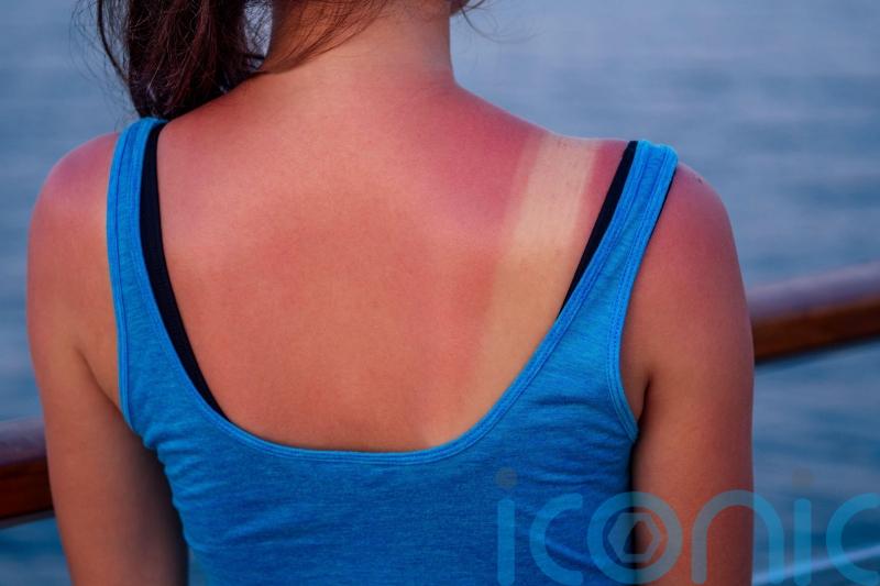 How to soothe painful sunburn