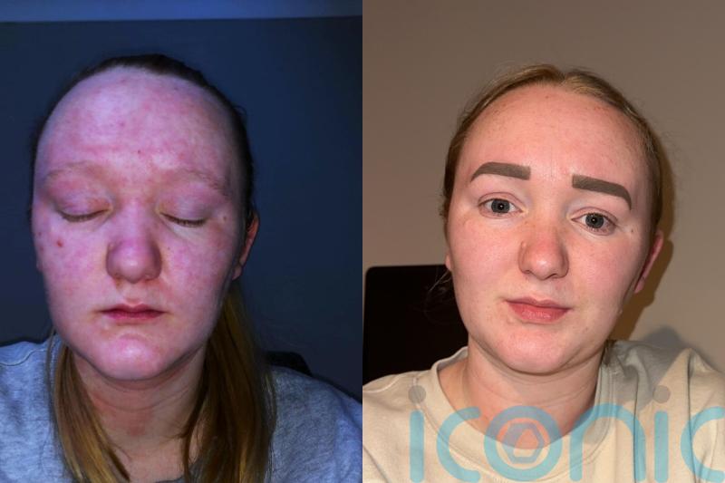 Mum bullied relentlessly over eczema finds ‘miracle’ donkey milk salve and can now go swimming for first time with kids