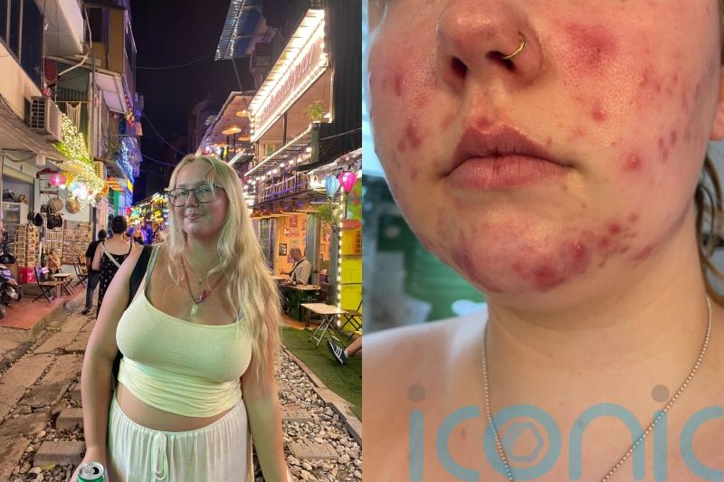 Teenager bullied about ‘painful’ cystic acne across her face and body ‘frustrated’ not knowing why skin has cleared
