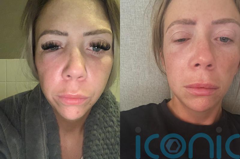 ‘I’m beautiful and I never needed it’: Mum’s facelift-gone-wrong forced her to postpone wedding and caused cancer scare