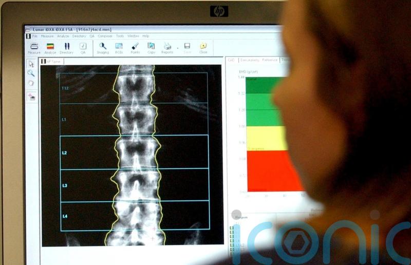 Vitamin D supplements in pregnancy shown to improve bone density in childhood