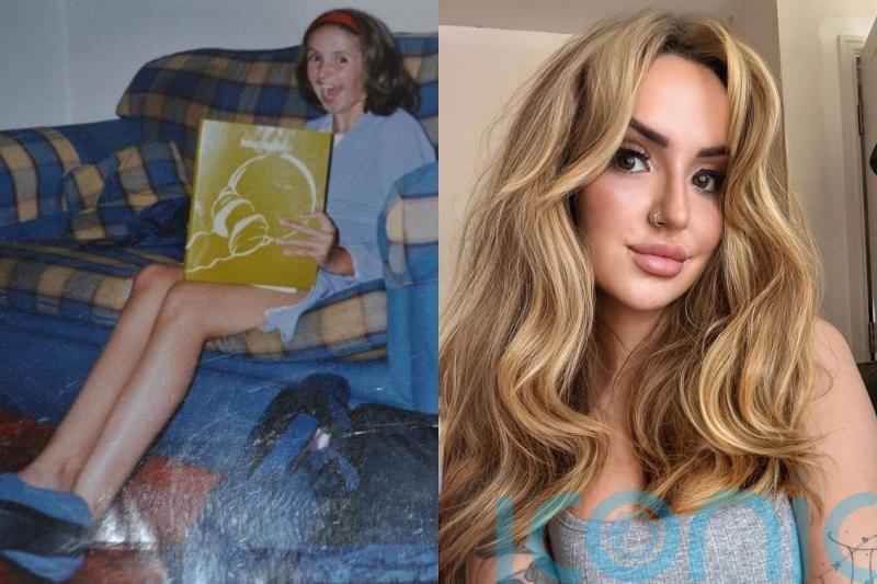 Mum with rare condition causing long limbs and hollow face has filler to ‘look normal’ after being called a ‘freak’