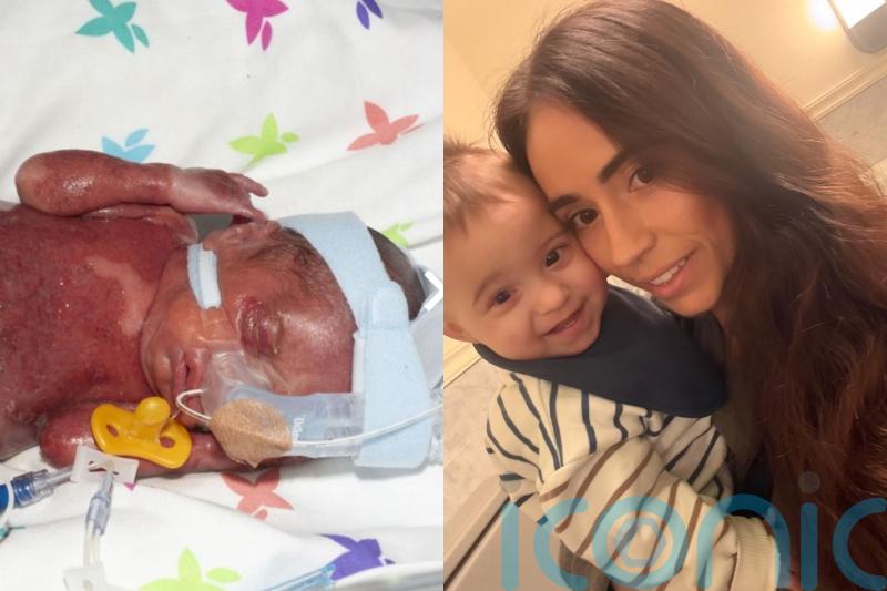 Baby who caught mother’s oral herpes in womb born three months early blind in one eye and looking ‘burnt all over’