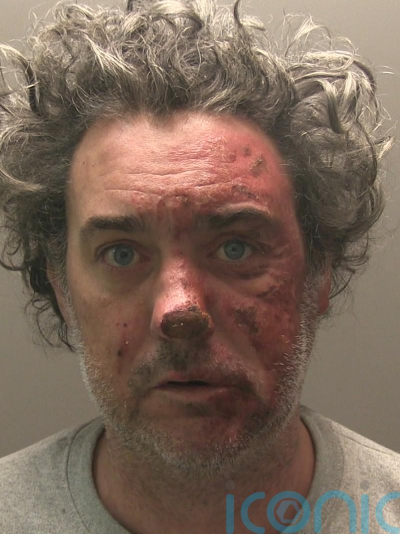 Man jailed for murdering partner who died two years after he set her alight