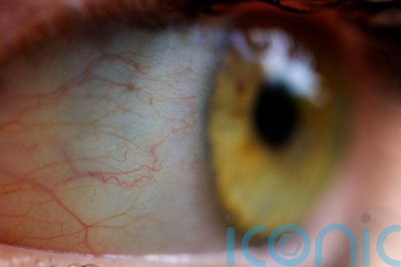 ‘Pioneering’ drug for rare eye cancer to be rolled out on NHS in England