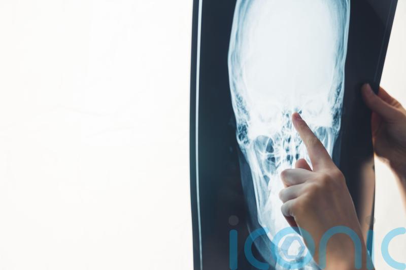 AI twice as accurate at pinpointing stroke time than current methods &ndash; study