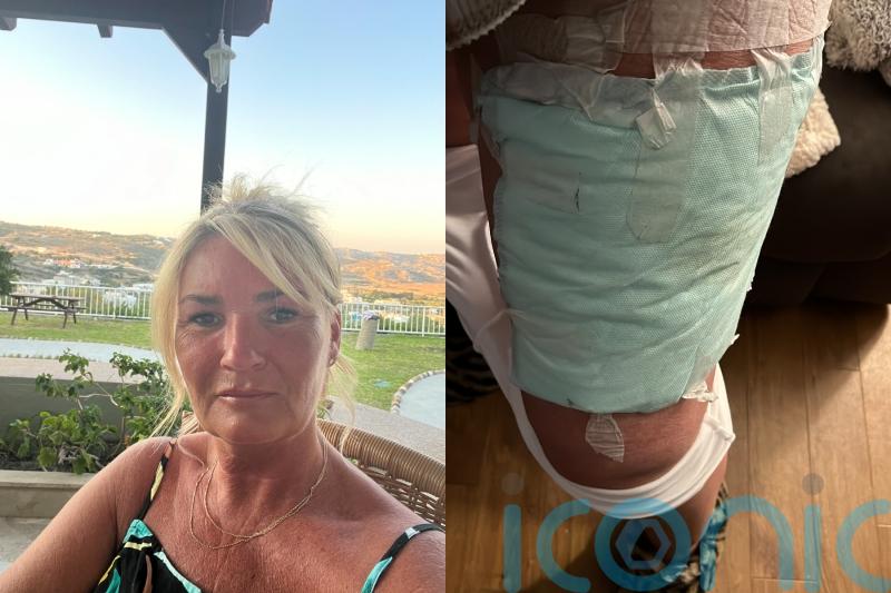 Mum left with third-degree burns and scar after hot water bottle burst urges others to ‘never ever’ use them