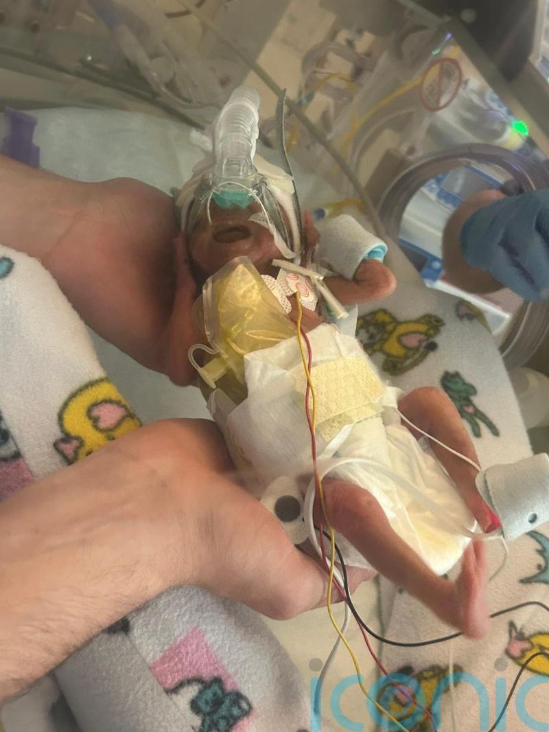 Parents praise medical staff for saving daughter born weighing just one pound