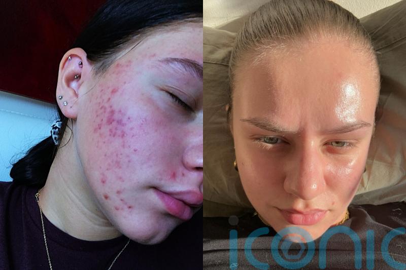 ‘Kids at school called me pizza face, spotty and ugly because of my acne – an advert on social media changed my life’