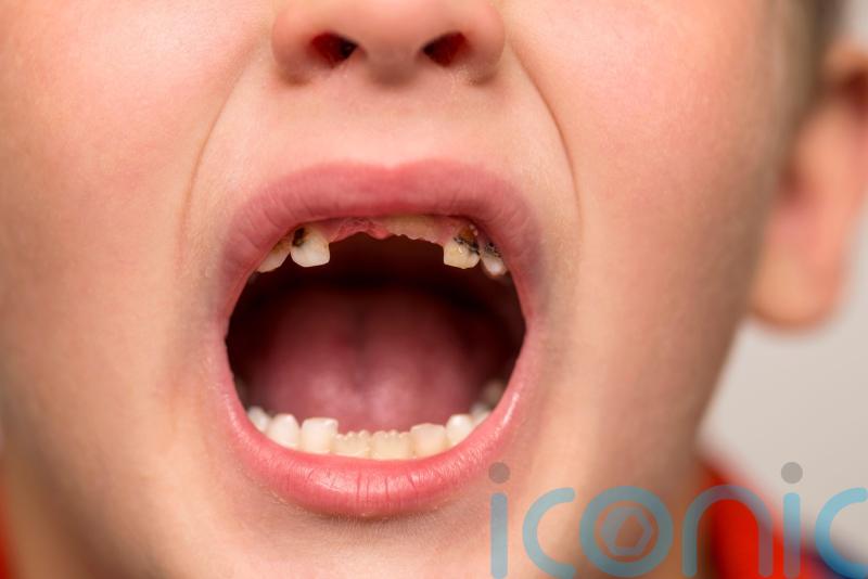 Amount of five-year-olds with rotting teeth rising in parts of England – data