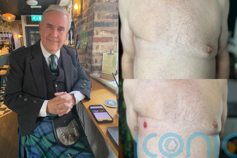 Dad who had right breast removed due to cancer gets ‘astonishing’ 3D nipple tattoo and finally feels ‘complete’ again