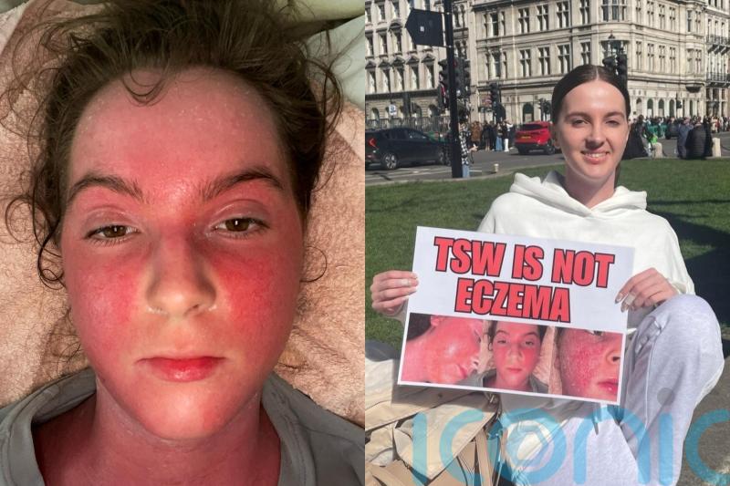 I would do anything to have eczema again, says 20-year-old afflicted by ‘burning’ and ‘oozing’ steroid cream withdrawal
