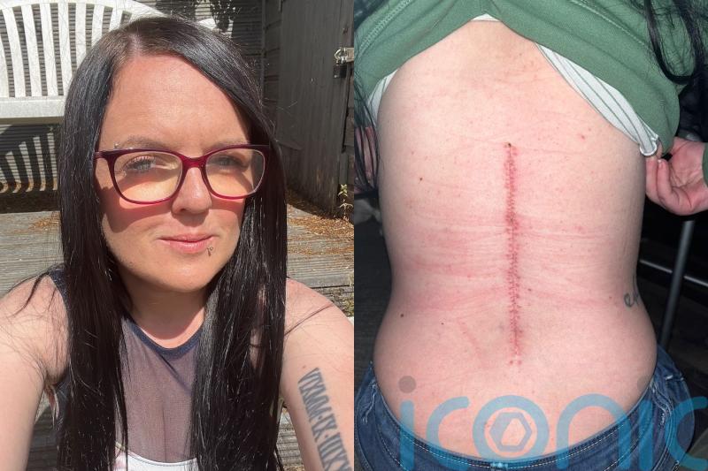 Mum found with large spinal cord tumour after 10 years of back pain will have to walk down the aisle on crutches