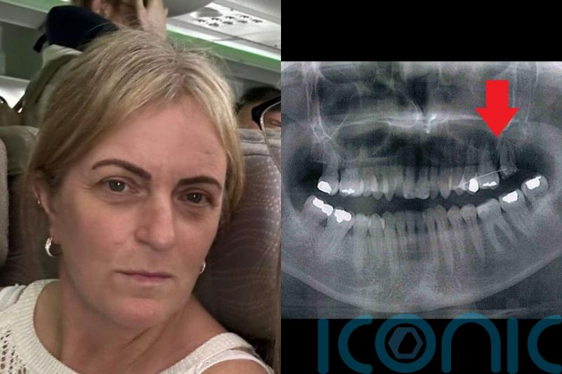 Mum receives £10,000 settlement after dentist broke her jaw during tooth extraction and bone later came out in her hand