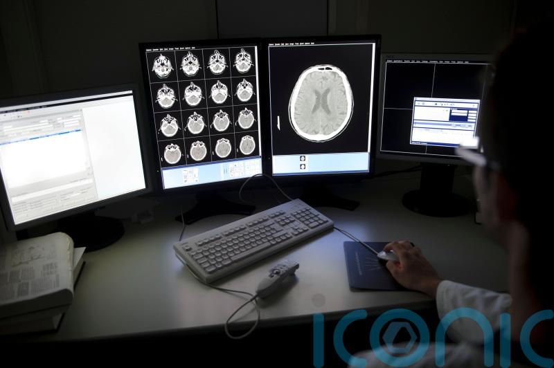 ‘Hope on the horizon’ as drugs assessed for Alzheimer’s prevention
