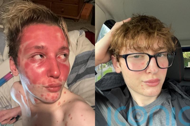 Influencer left looking ‘like an alien’ after fillers triggered psoriasis finds miracle product to soothe painful skin