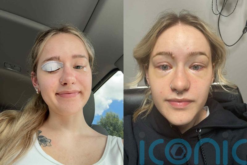 Young woman, 23, with extreme dry eye condition who needs drops made from own blood urges others to ‘cherish’ eye health