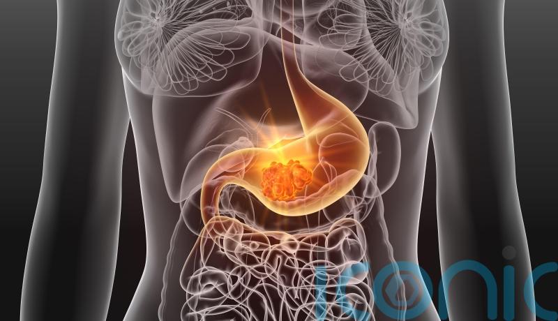 Common bacteria ‘fuels millions of cases of stomach cancer across the globe’
