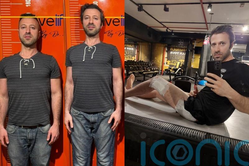 ‘Short king’ pays £36k on surgery to break legs and increase height by 3.7in after feeling arms were ‘too long’ for body