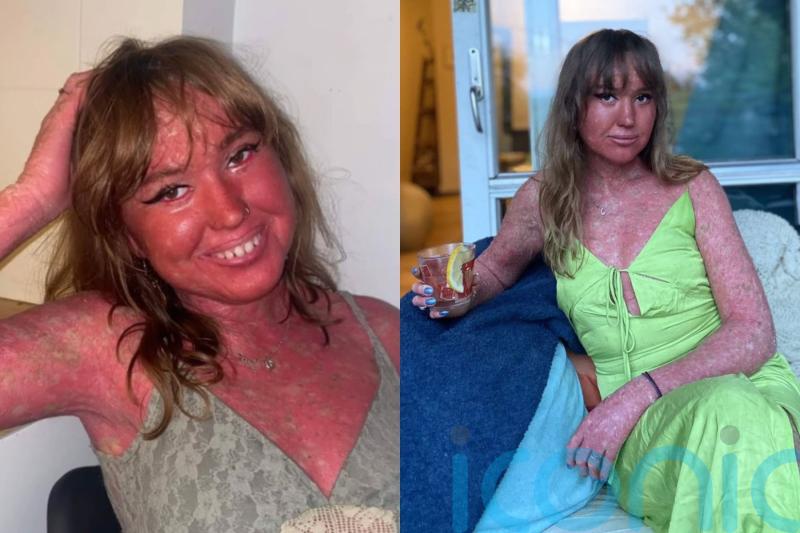 Woman bullied for rare condition making her one of ’40 reported cases worldwide’ says scaly skin is ‘cool and unique’