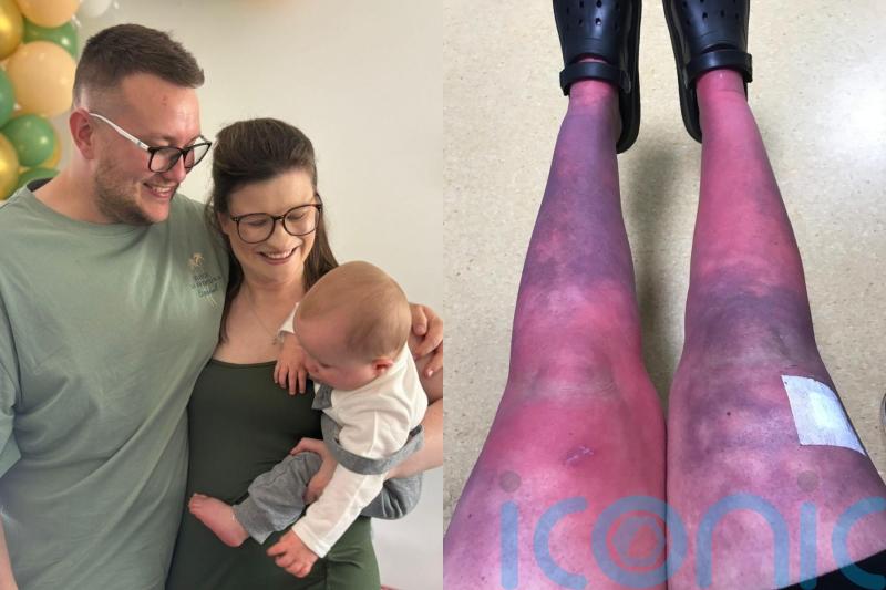 ‘It’s like I’m burning alive’ – Mum says rare condition robbed her of ‘everything’ from motherhood to independence