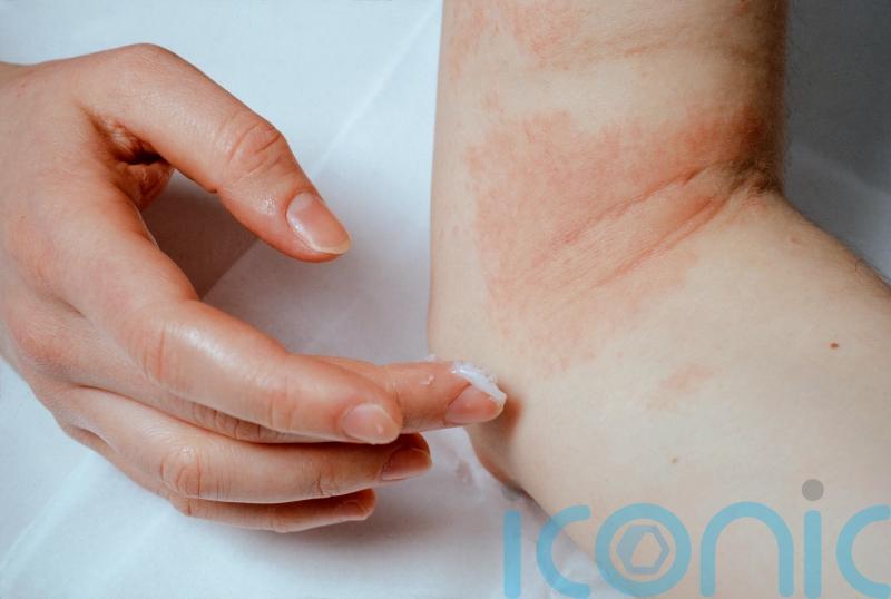 Best psoriasis-friendly skincare routine