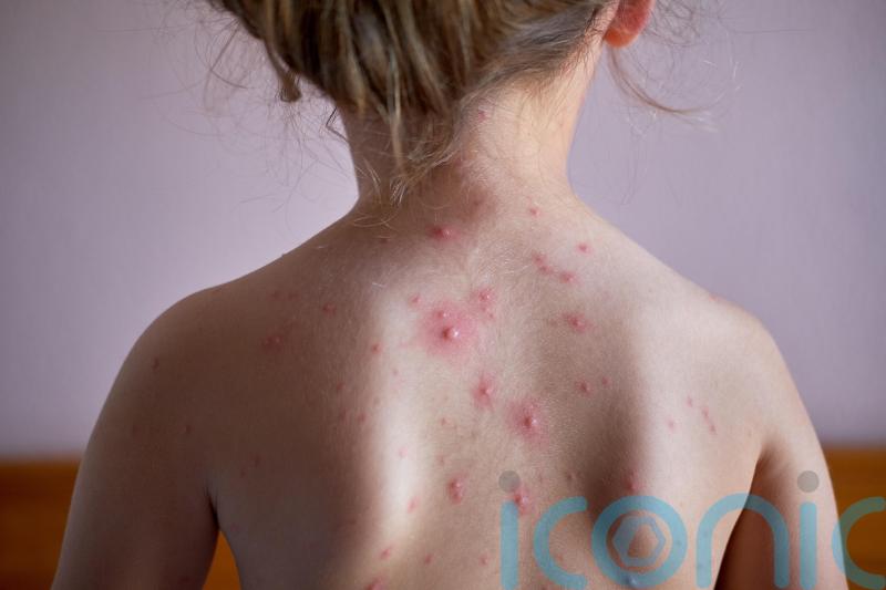 Vaccine for chickenpox to be rolled out on the NHS