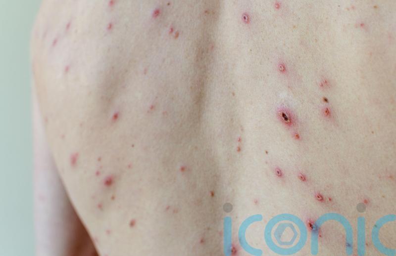 Minister urges take-up of chickenpox jab to defeat vaccine conspiracy theorists