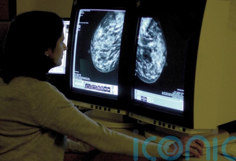 AI could detect heart risk from breast screening images, study suggests
