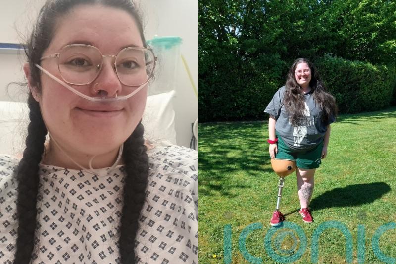 NHS nurse who had leg amputated after rare tumour found in calf says going into ‘survival mode’ helped her ‘stay positive’