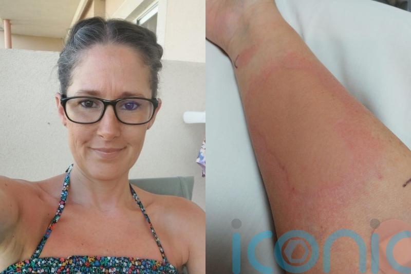 ‘I’m allergic to the cold – I break out in hives like nettle stings and my skin is so itchy I want to rip it off’