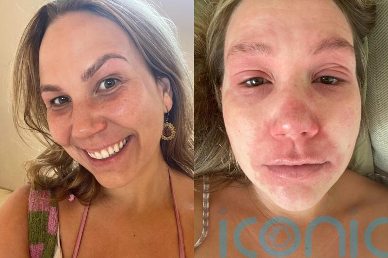 ‘I used steroid creams for 10 years and the withdrawal left me in never-ending agony – recovery has taught me self-love’