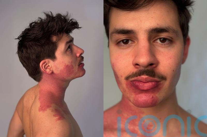 Twin with port wine stain on face says he feels &lsquo;lucky&rsquo; to be different and now champions self-acceptance after coming out as gay