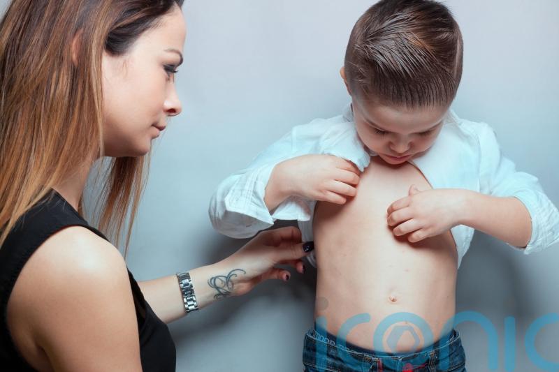 6 subtle warning signs of measles in children &ndash; and how to prevent it
