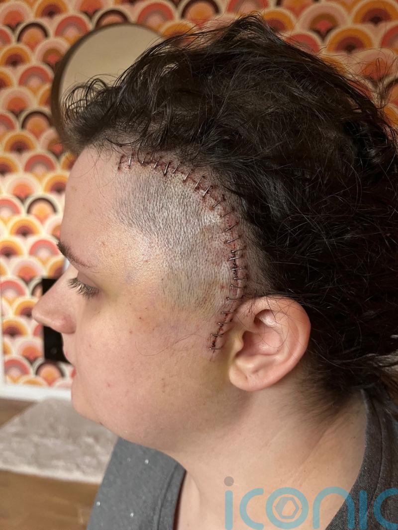 Student to be &lsquo;first in queue&rsquo; as new brain tumour treatment approved for NHS