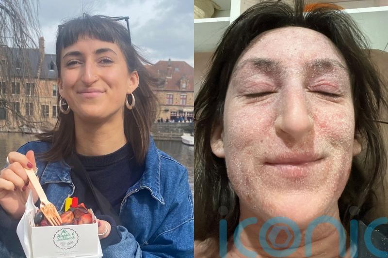 Woman &lsquo;left bedbound and unrecognisable with oozing, elephant-like skin&rsquo; after 28 years of steroid cream use for eczema