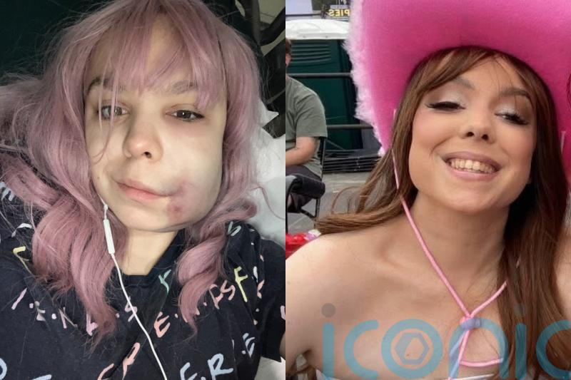 Ultramarathon runner, 26, &lsquo;grieves&rsquo; former self after arthritis diagnosis and now finding daily tasks &lsquo;impossible&rsquo;